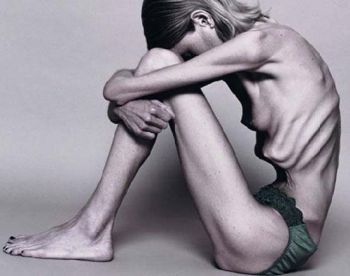 TRIST: modelul anorexic care a pozat nud a murit la 28 de ani