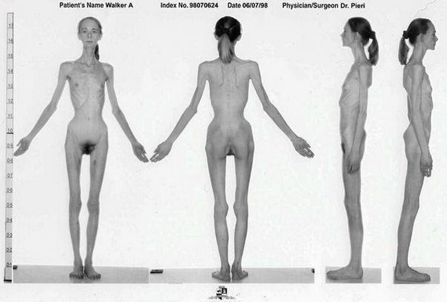 Pe urmele lui Isabelle Caro, modelul care a murit de anorexie - o tanara a ajuns piele si os! La propriu!