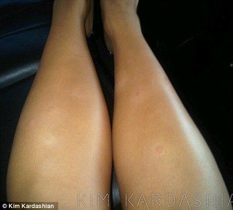 Kim Kardashian nu reuseste sa scape de psoriazis, dar a gasit o metoda sa-si ascunda bubitele! FOTO