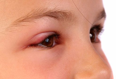 Cum protejam copiii de alergiilor oculare de primavara