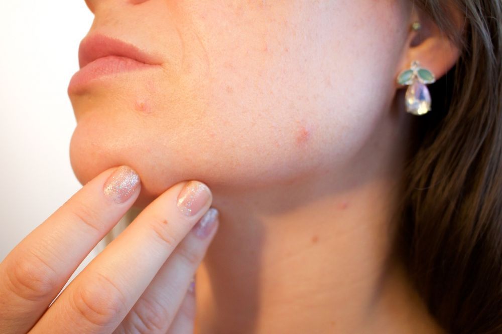 Cum tratăm acneea la maturitate?
